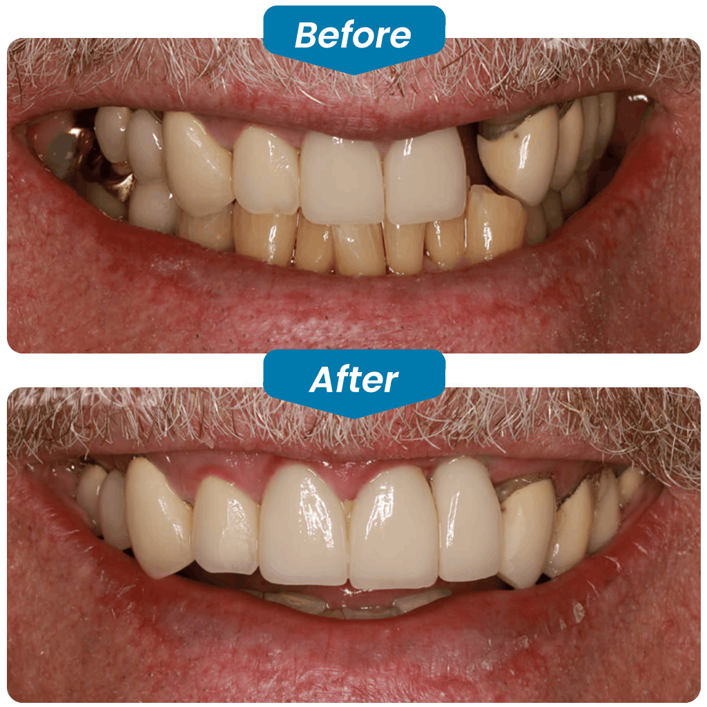 before & after my dental implants