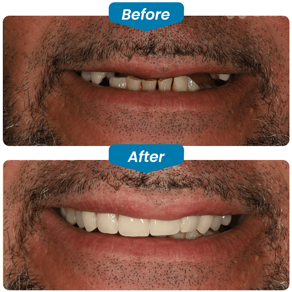 before & after my dental implants