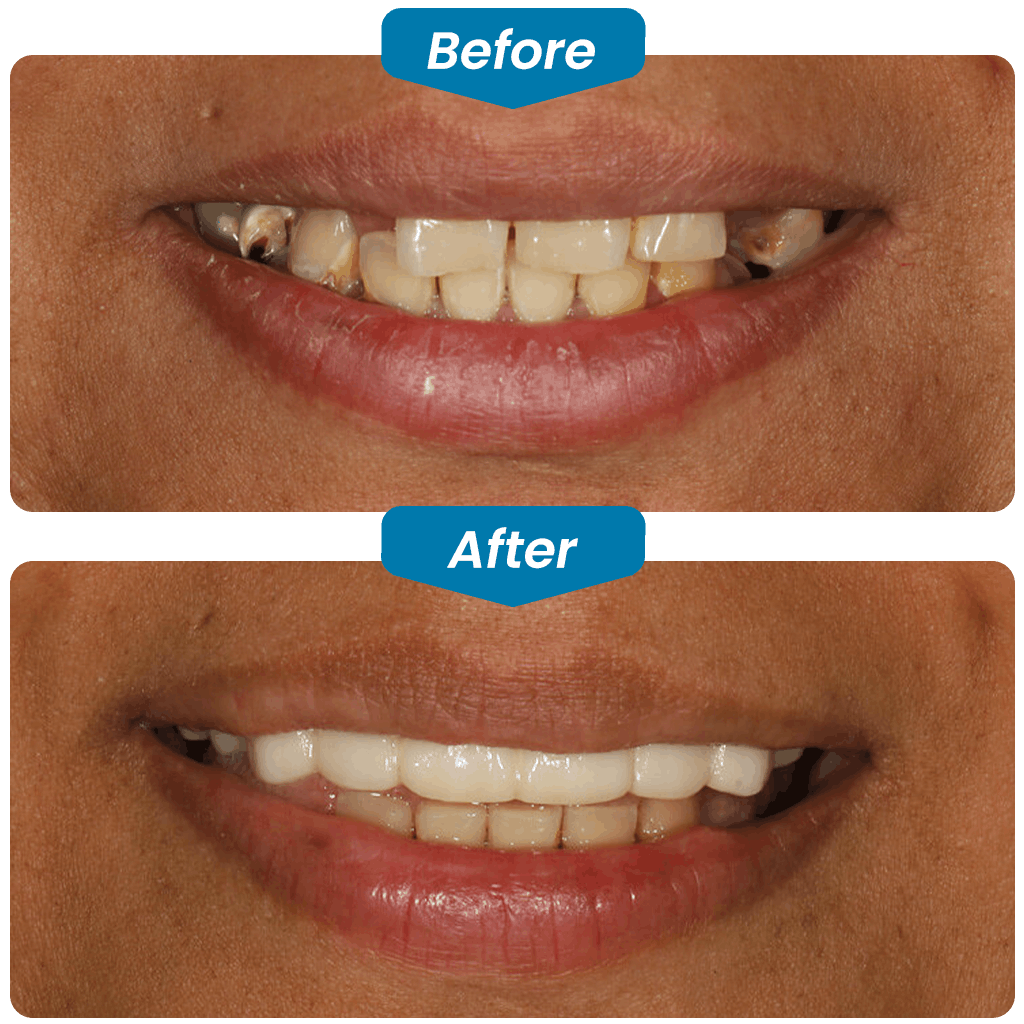 before & after my dental implants