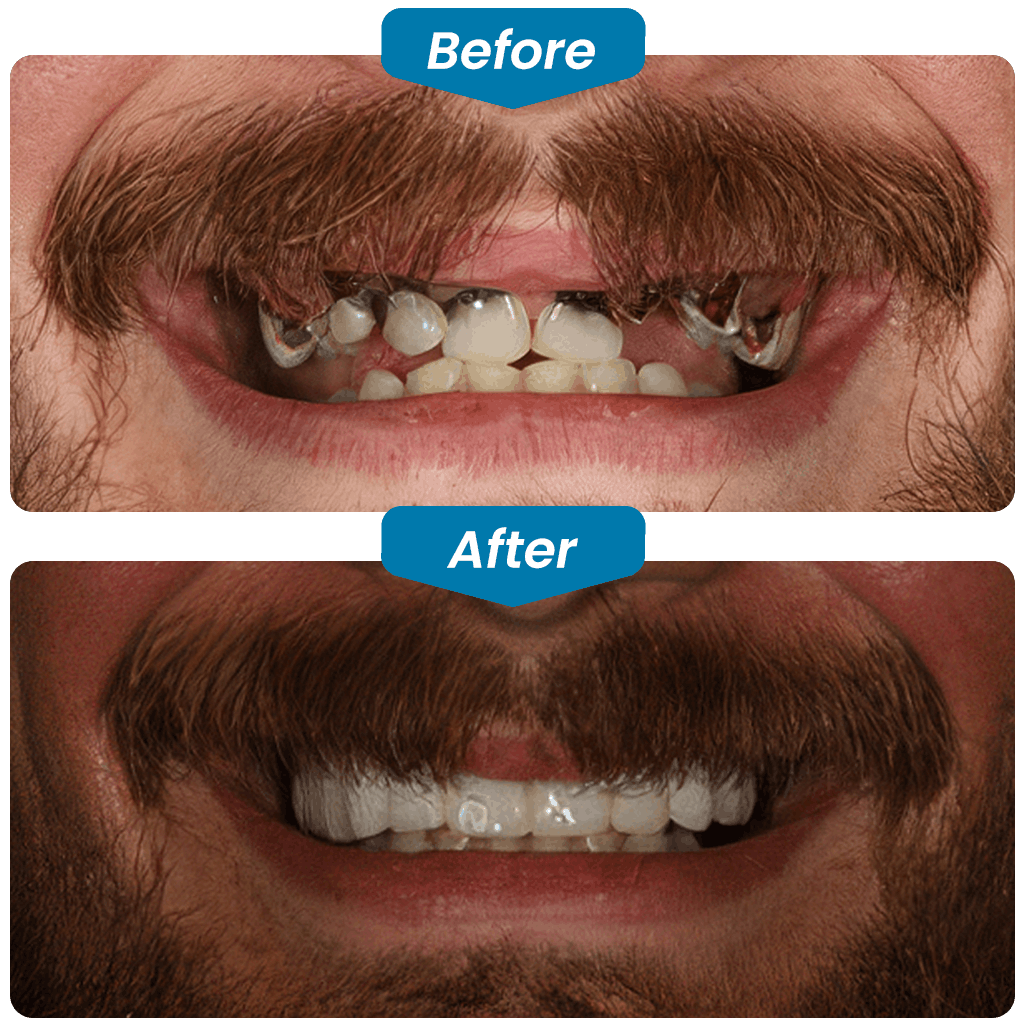 before & after my dental implants