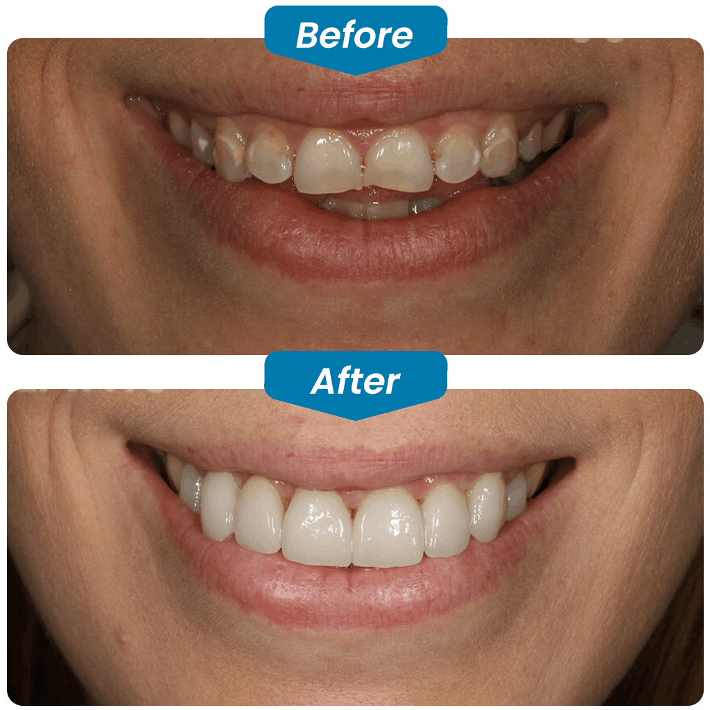 before & after my dental implants