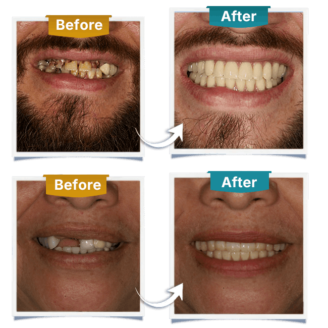 Implant dentiistry - Before After